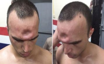 L’impressionnante blessure au crâne d’un boxeur après un coup de coude ! (Vidéo)