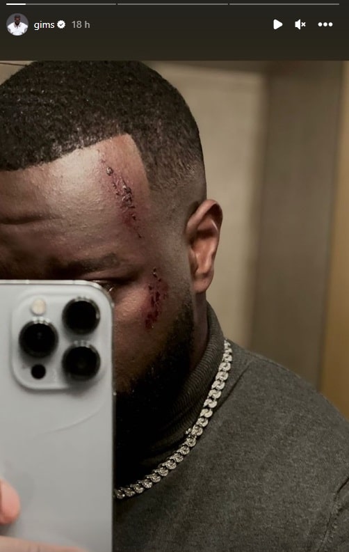 Du sang sur le visage, Gims inquiète ses fans avec une mystérieuse blessure 2